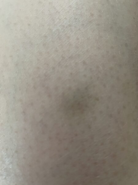 瘀斑、瘀傷(英語:Bruise),或稱瘀血(英語:Ecchymosis)、瘀青,是指直徑10公釐以上的皮下出血點。圖/Chulichun