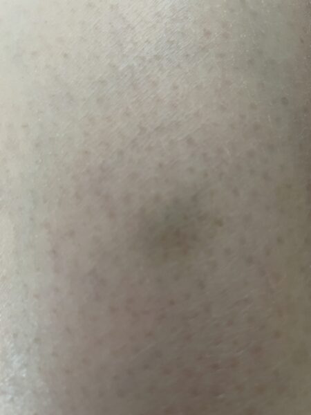瘀斑、瘀傷（英語：Bruise），或稱瘀血（英語：Ecchymosis）、瘀青，是指直徑10公釐以上的皮下出血點。圖／Chulichun