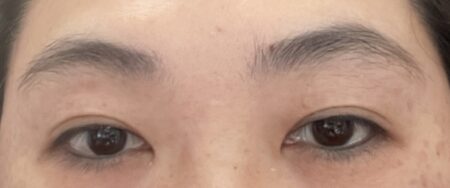 乾眼症是一種常見的眼部疾病，尤其在現代辦公環境中尤為普遍。圖／資料庫